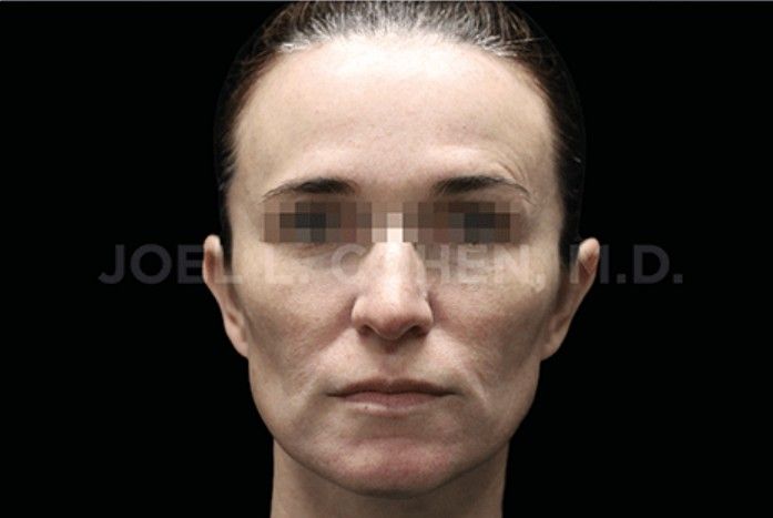 tratamiento emface clinica tufet