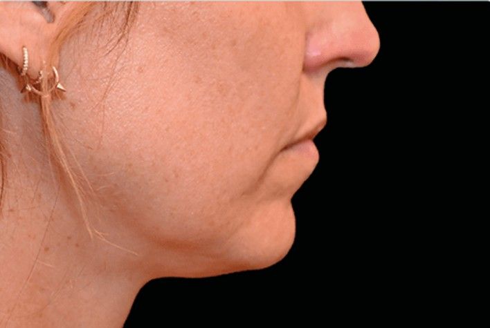 tratamiento emface clinica tufet