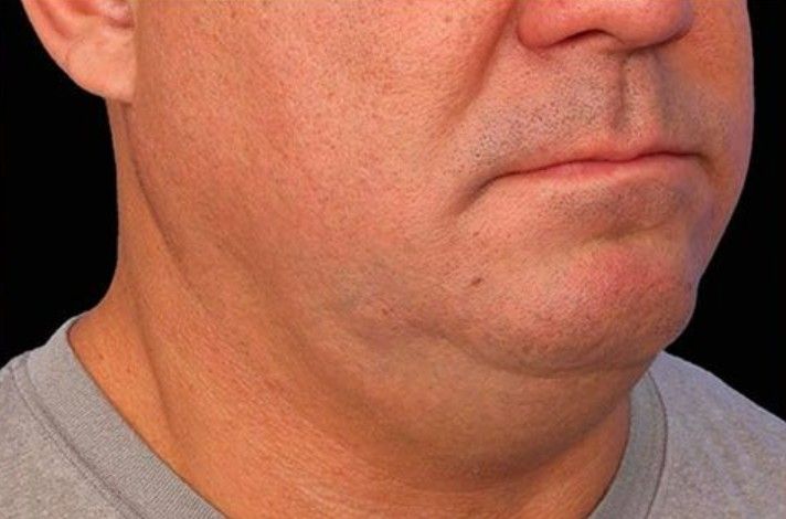 tratamiento emface clinica tufet