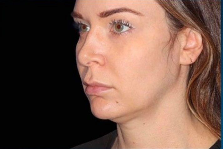 tratamiento emface clinica tufet