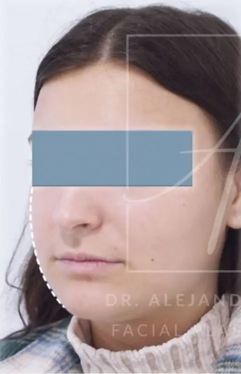 bichectomia clinica tufet