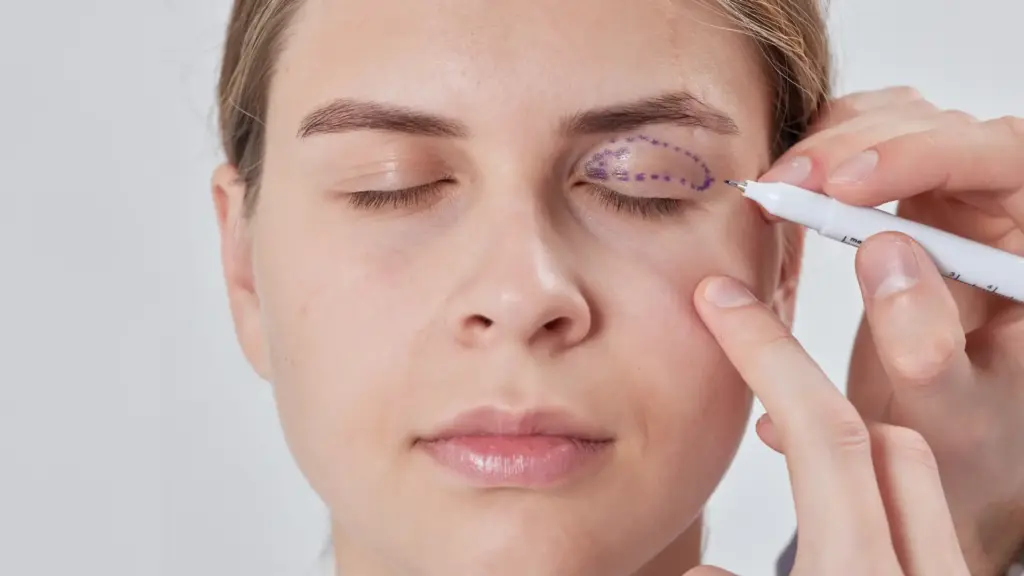 blepharoplasty