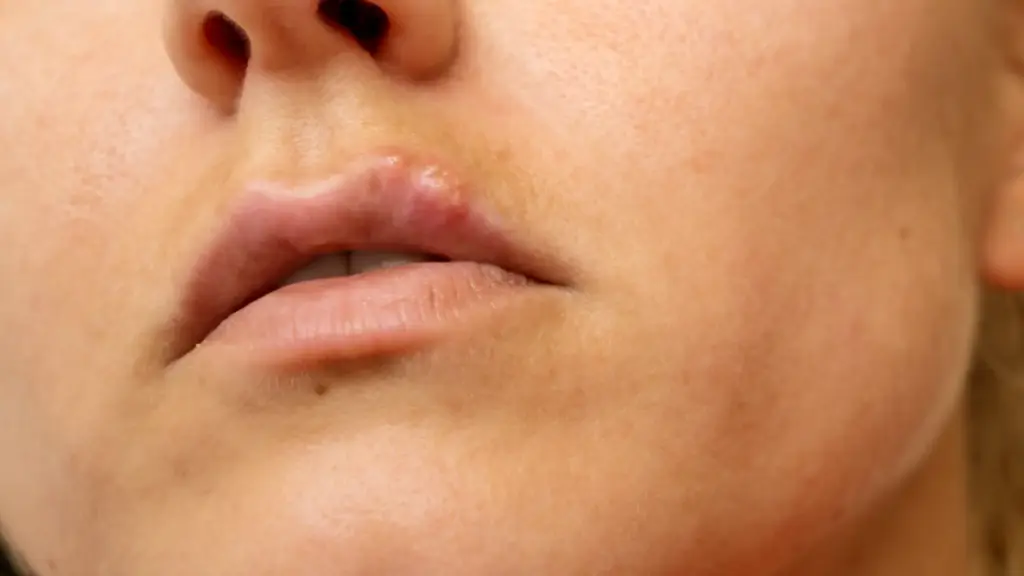 clinica tufet herpes