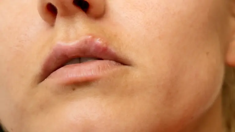 clinica tufet herpes