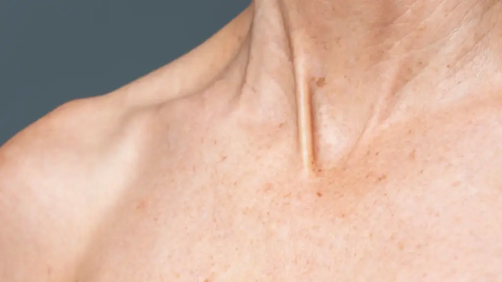 clinica tufet queratosis seborreica