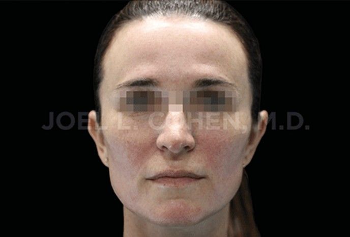 tratamiento emface clinica tufet