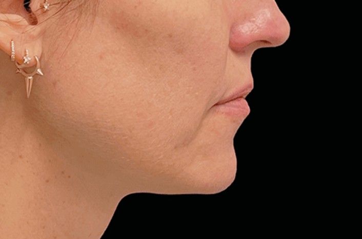 tratamiento emface clinica tufet