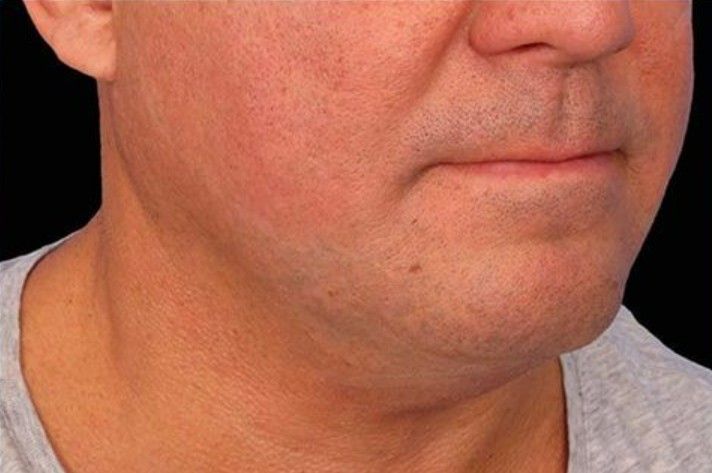 tratamiento emface clinica tufet