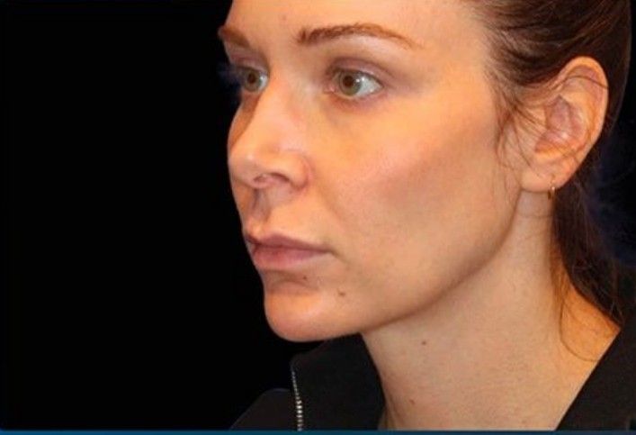 tratamiento emface clinica tufet