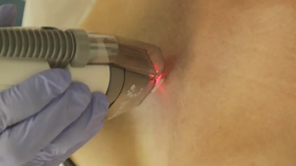 fraxel laser spots face