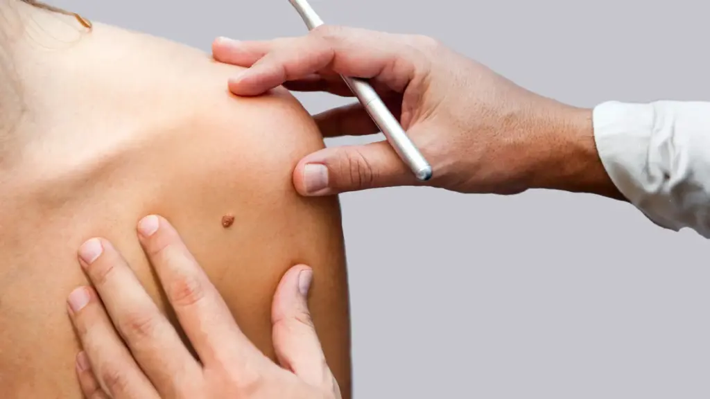 clinica tufet nevus lunares
