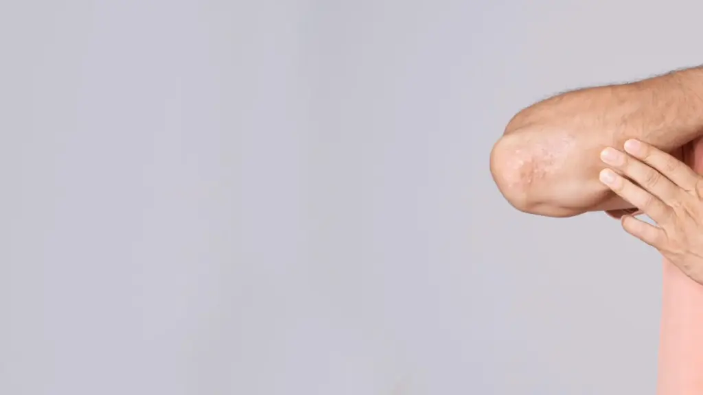 tratmaiento psoriasis