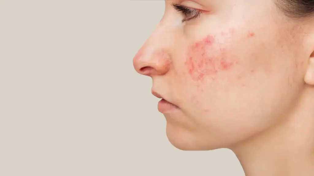 clinica tufet rosacea