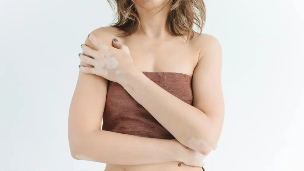 clinica-tufet-vitiligo