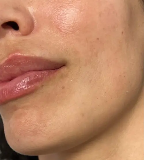 antes y despues melasma