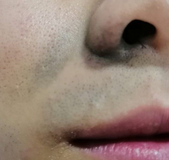 tratamiento de nevus de ota