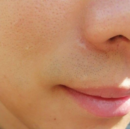 tratamiento de nevus de ota