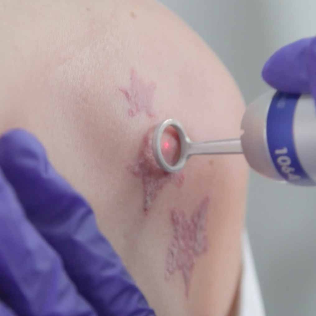 unidad de eliminacion de tatuajes clinica tufet