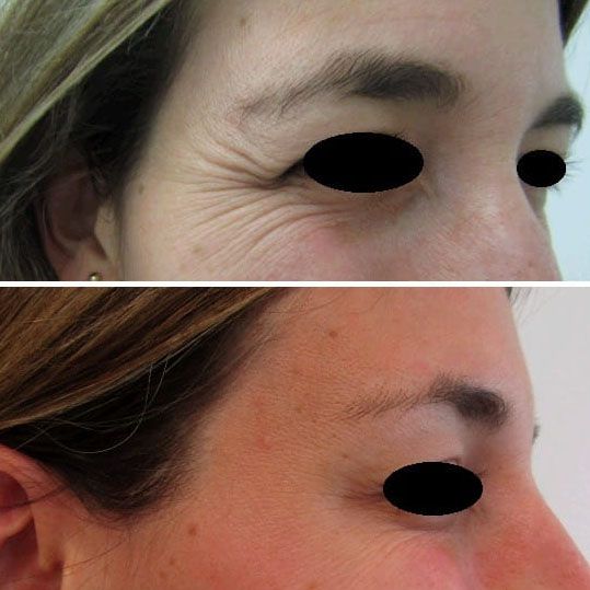 before and after wrinkles crow's feet