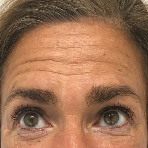 antes y despues tratamiento para arrugas de expresion