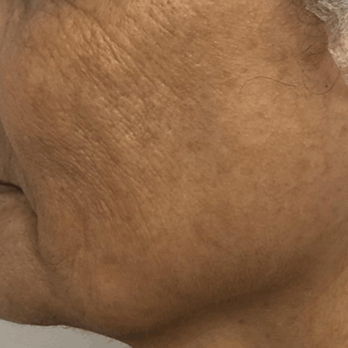 antes y despues exo-regene clinica tufet