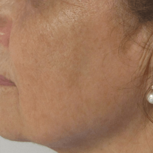 antes y despues exo-regene clinica tufet