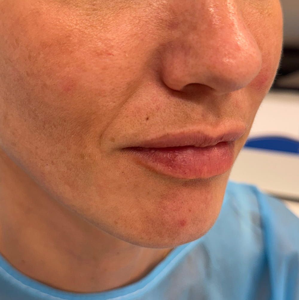 cerrar agujero de piercing en el labio