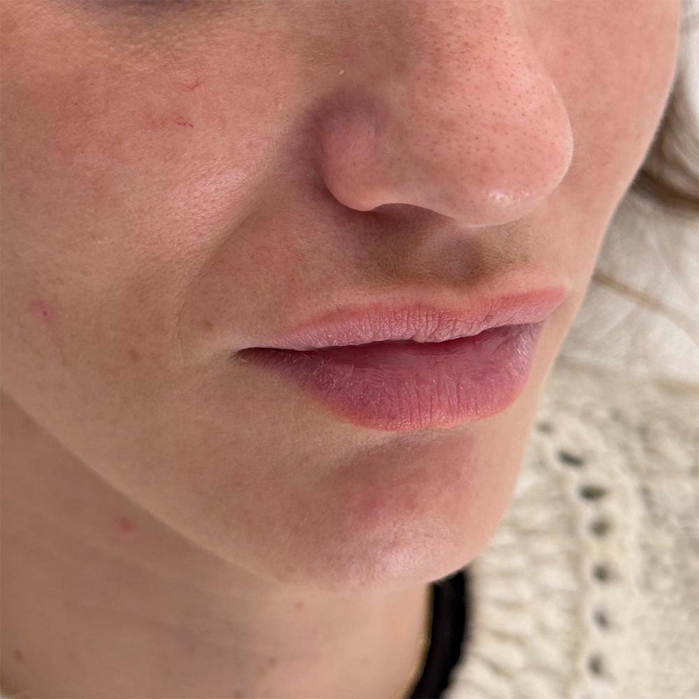 cerrar agujero de piercing en el labio