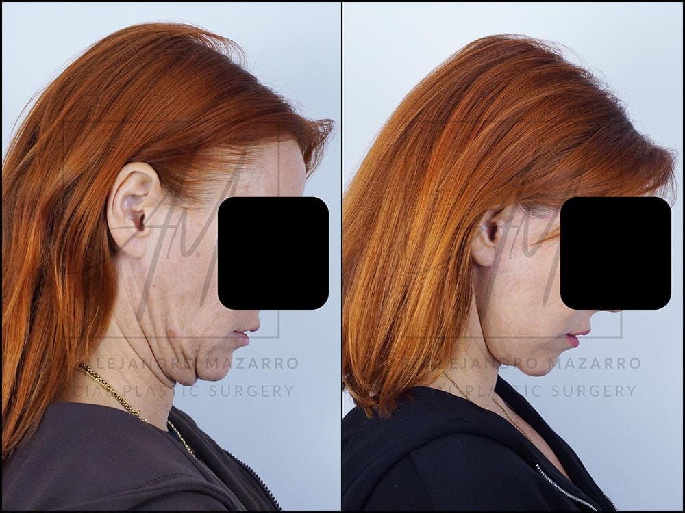 lifting facial barcelona