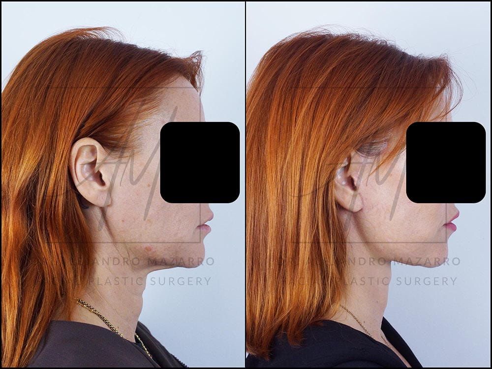 lifting facial barcelona