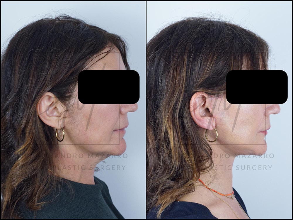 lifting deep plane clinica tufet barcelona