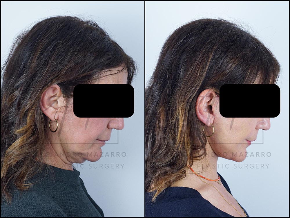 lifting deep plane clinica tufet barcelona