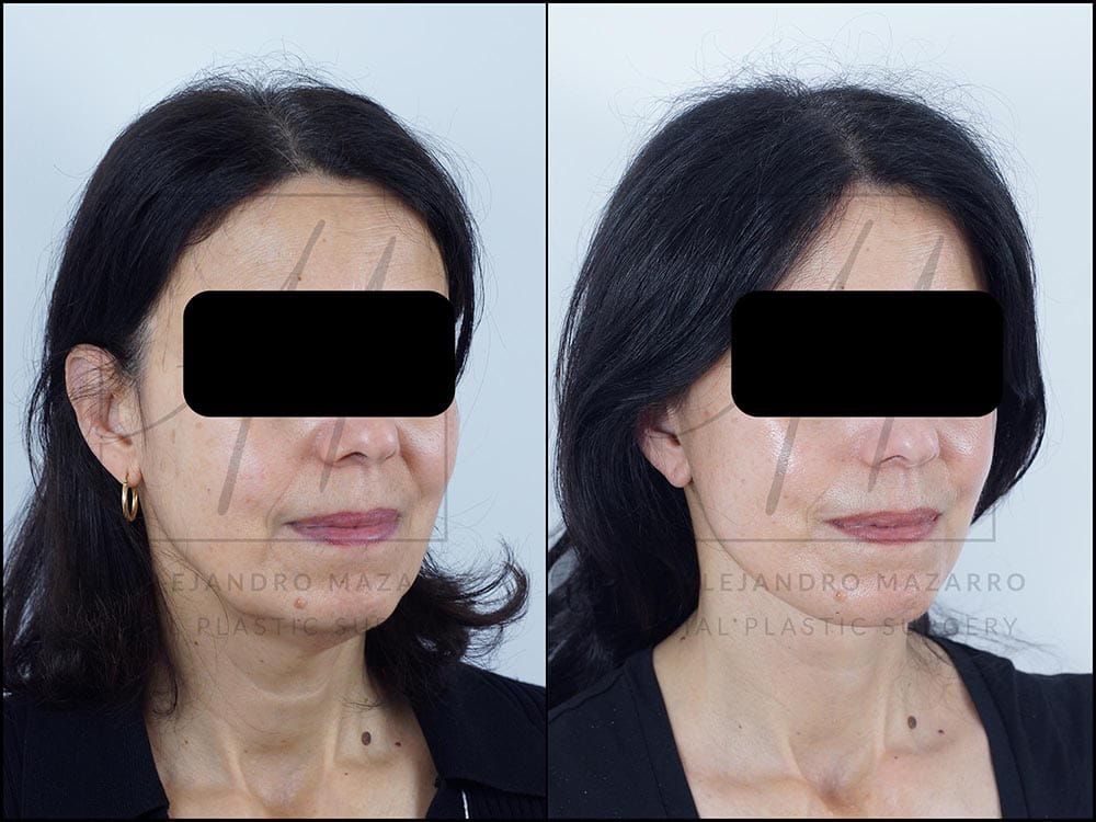 antes y despues lifting deep plane clinica tufet barcelona