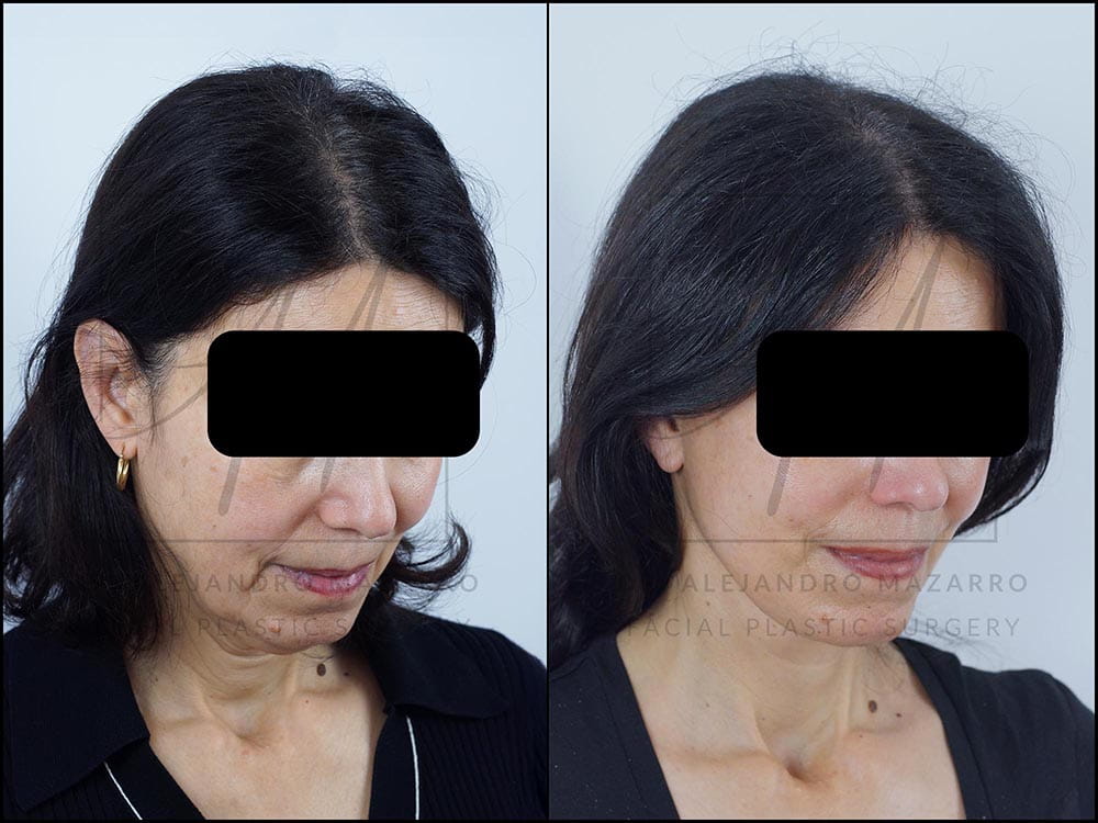 antes y despues lifting deep plane clinica tufet barcelona