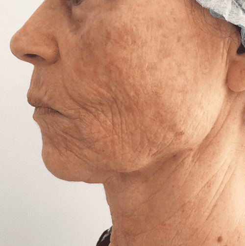 tratamiento para flacidez facial