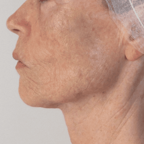 antes y despues exo regene